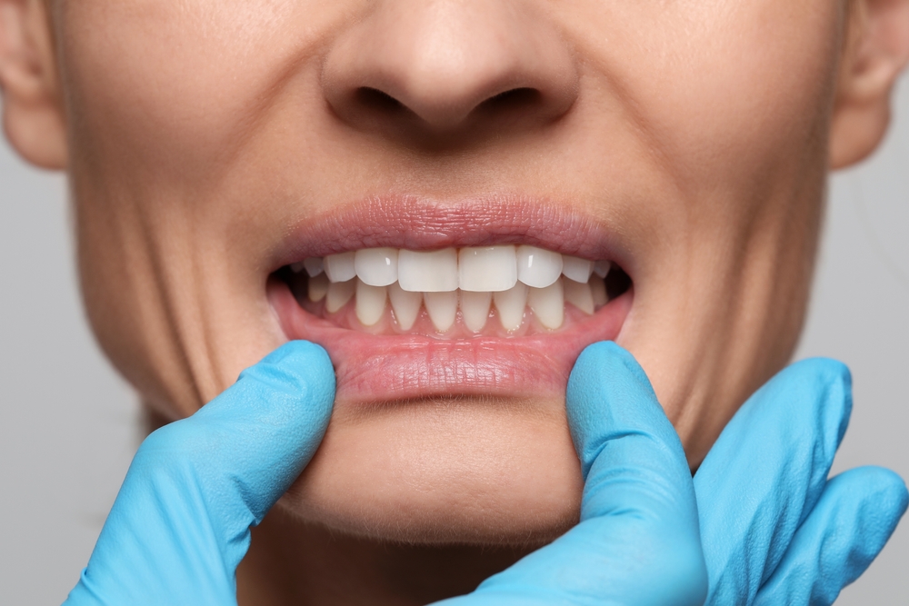 Close-Up of Dentist Examining Patient’s Gums and Teeth – Cosmetic Dentistry A dental professional wearing blue gloves gently pulling down a woman’s lower lip to examine her teeth and gums during a cosmetic dentistry consultation – Cosmetic Dentistry