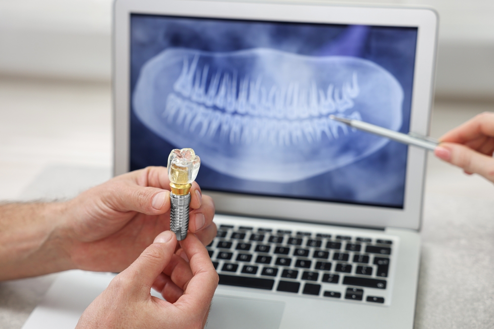 Dental Implant Demonstration with X-Ray – General Dentistry Hands holding a dental implant model while pointing to a dental X-ray on a laptop during a general dentistry consultation – General Dentistry