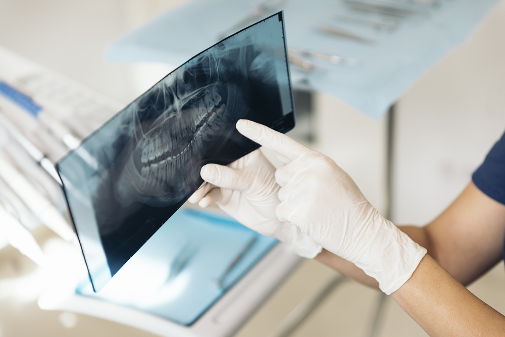 Dentist pointing at dental x-ray - dental x-rays