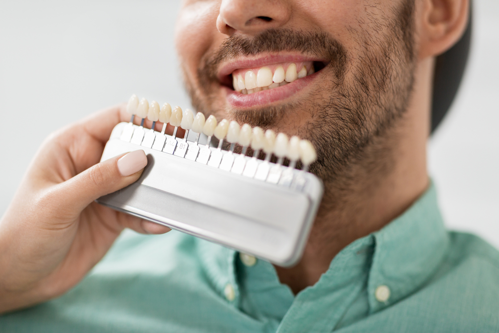 Man Matching Tooth Shade for Smile Makeover – Cosmetic Dentistry A close-up of a man smiling as a dental professional holds a tooth shade guide to match his teeth for a cosmetic procedure – Cosmetic Dentistry