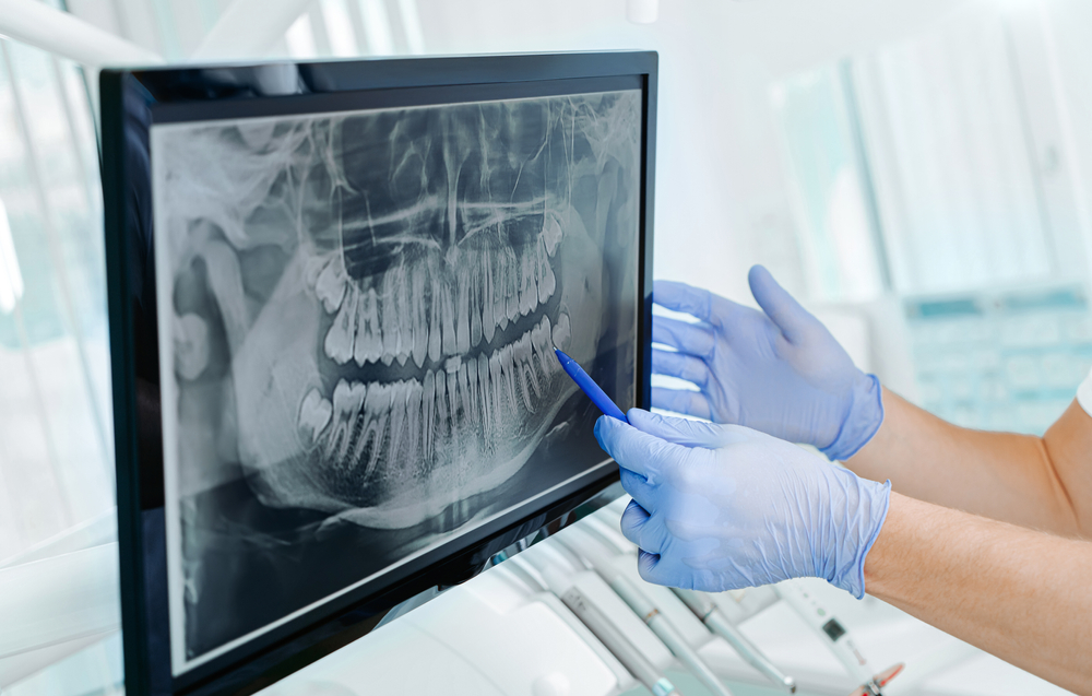 Gloved hands of a dental professional point to a panoramic dental X-ray displayed on a monitor, reviewing jaw and tooth structure during a consultation – Dentist in South Hill WA
